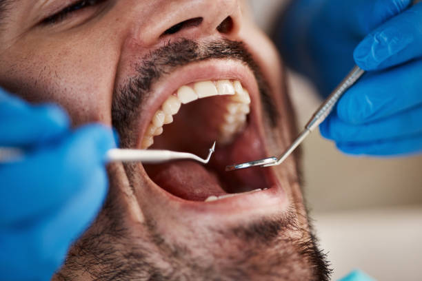 Best Knocked-Out Tooth (Avulsed Tooth) Treatment in Fredericksburg, VA