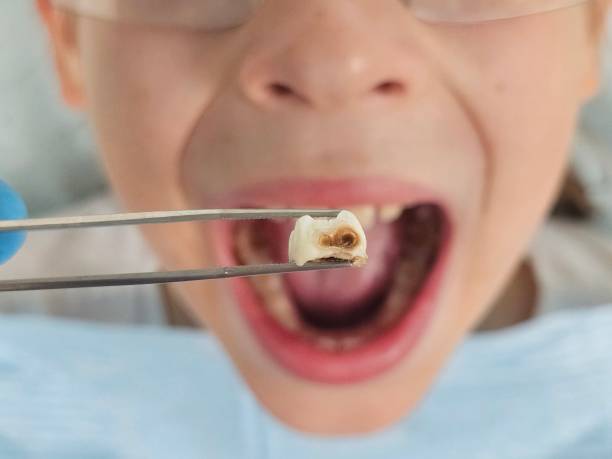 Best Emergency Dental Care for Sports Injuries in Fredericksburg, VA